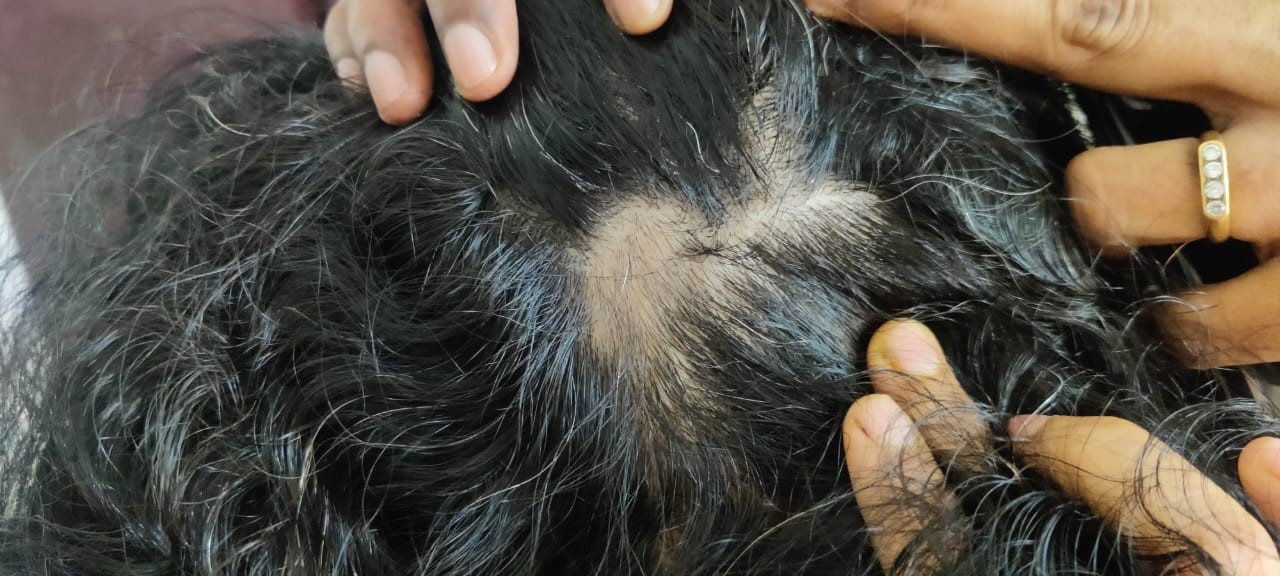 Alopecia Areata Treatment